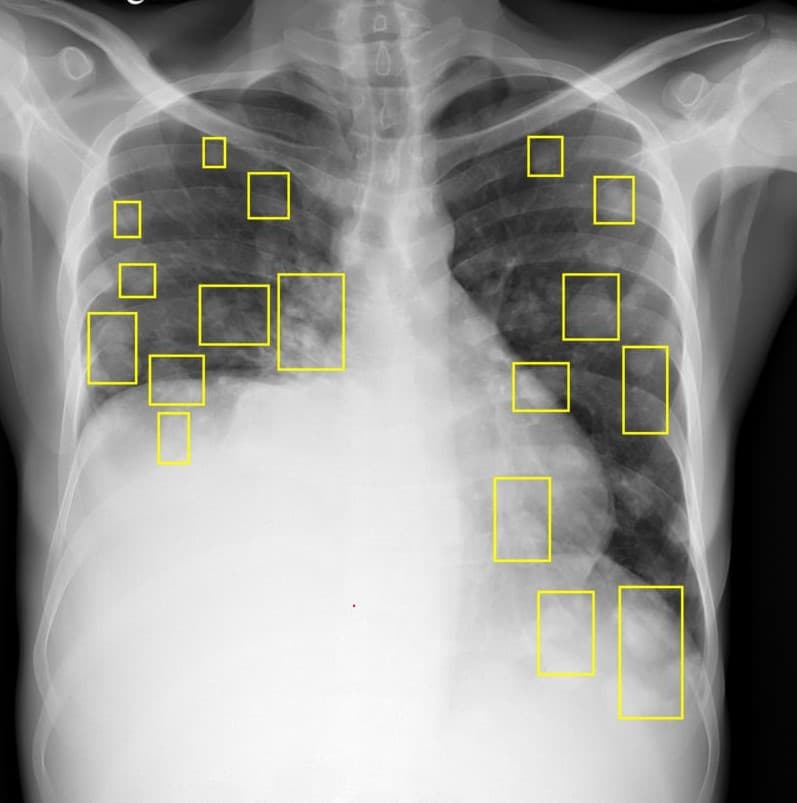 Chest X-Ray Annotation