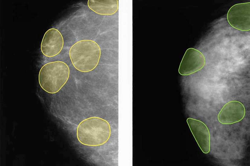 Mammography Analysis
