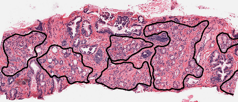 Oncology Pathology Annotation